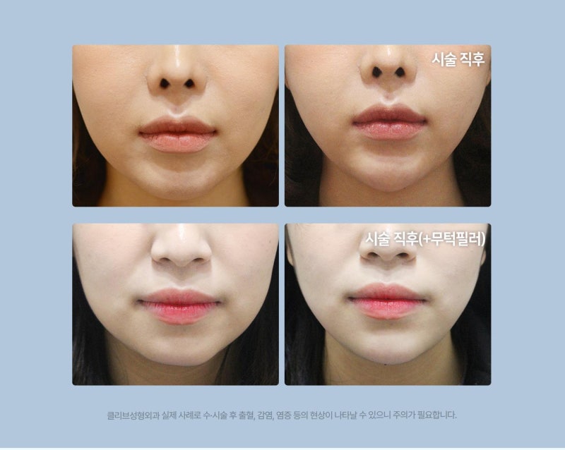 실리프팅잘하는병원 클리브성형 올인원 V라인 이벤트