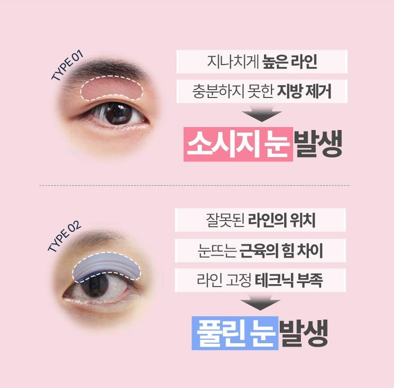 신사역눈재수술 잘하는 병원 클리브 성형외과에서