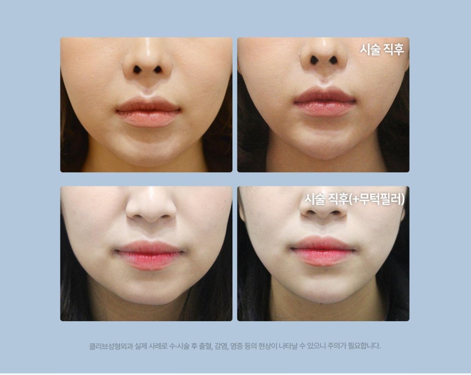신사역실리프팅 민트실과 진행하는 브이라인 패키지
