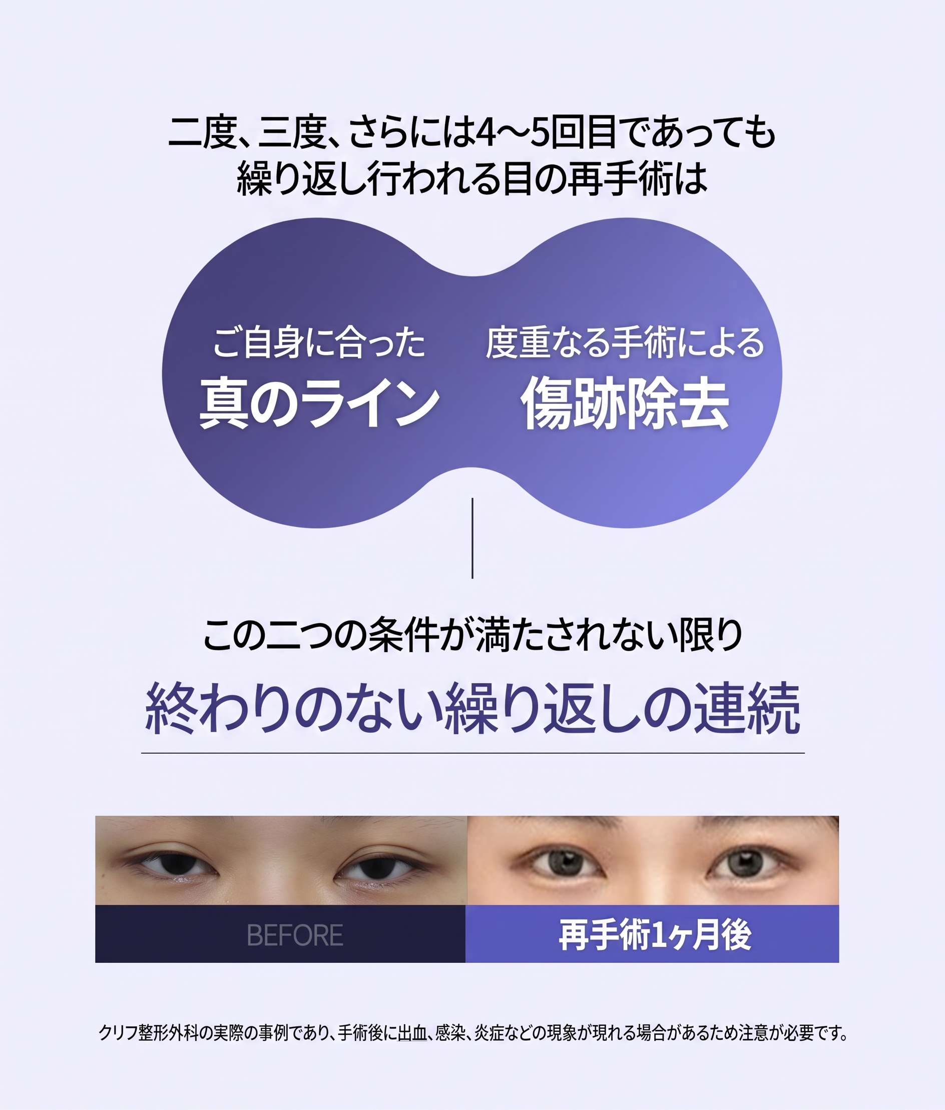 ノンヒョン駅整形外科の目の再手術、再手術が必要なケースと方法は？ 사진 5