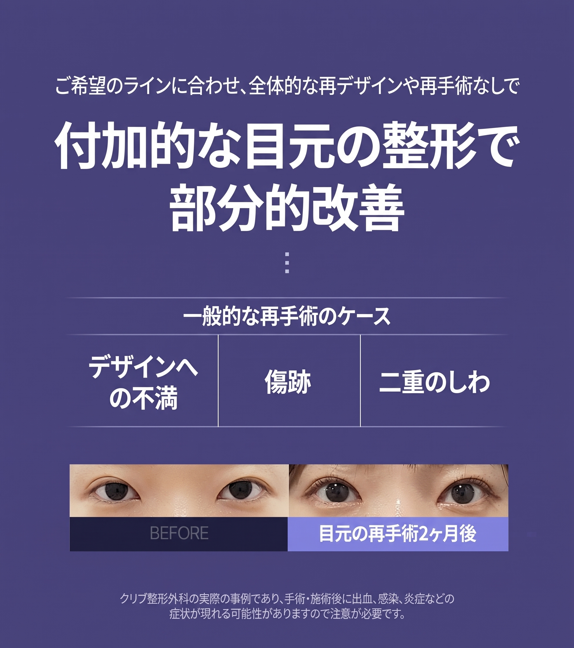 ノンヒョン駅整形外科の目の再手術、再手術が必要なケースと方法は？ 사진 4