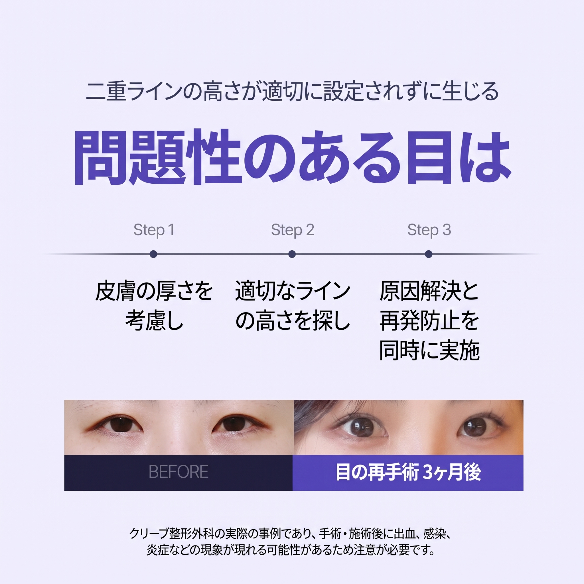 ノンヒョン駅整形外科の目の再手術、再手術が必要なケースと方法は？ 사진 3