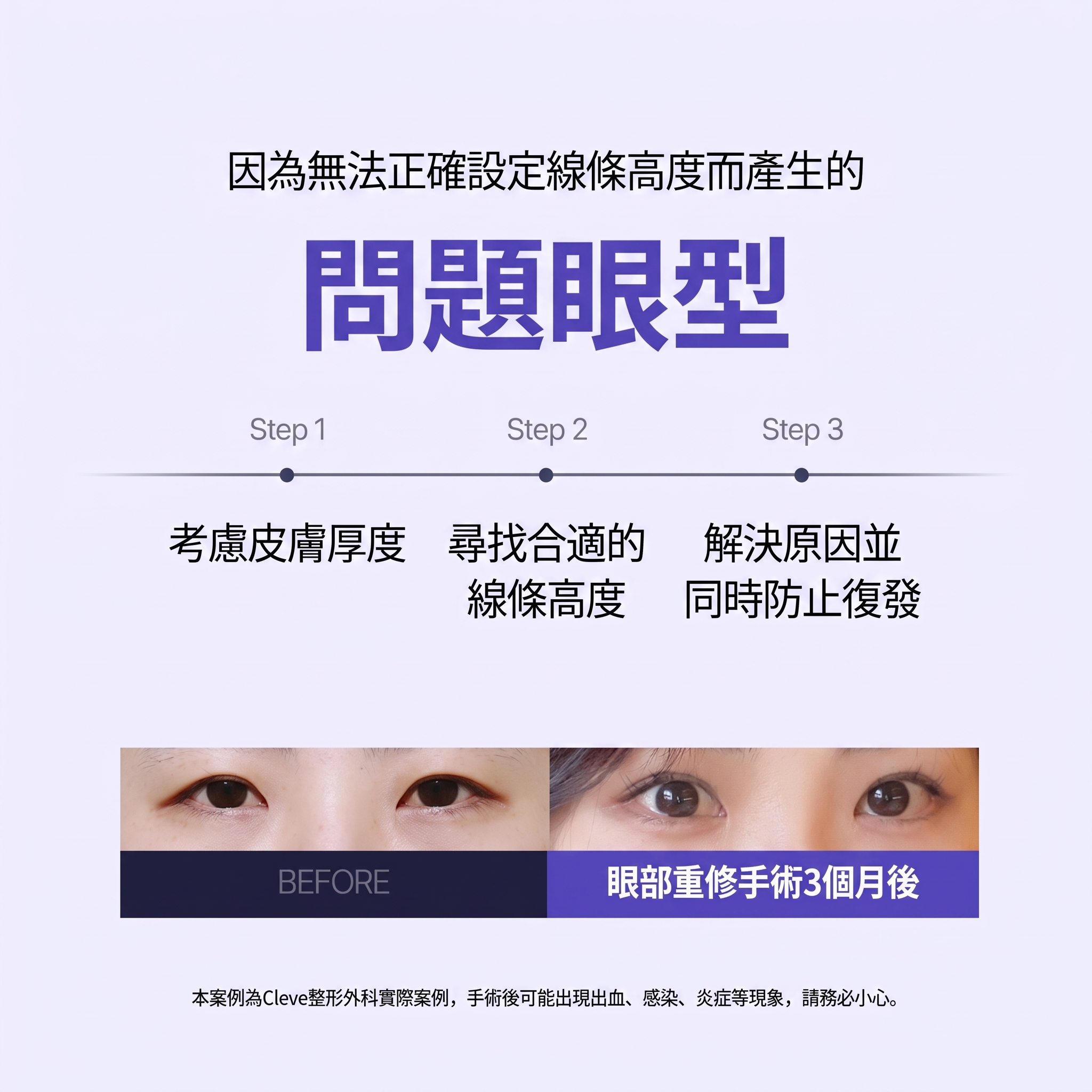 論峴站整形外科眼睛重修手術，哪些情況需要重修以及如何進行？ 사진 3