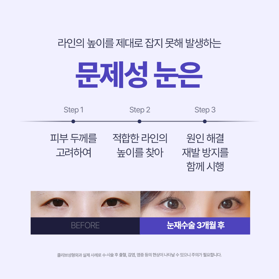 논현역성형외과 눈재수술, 다시 해야 하는 경우와 방법은?