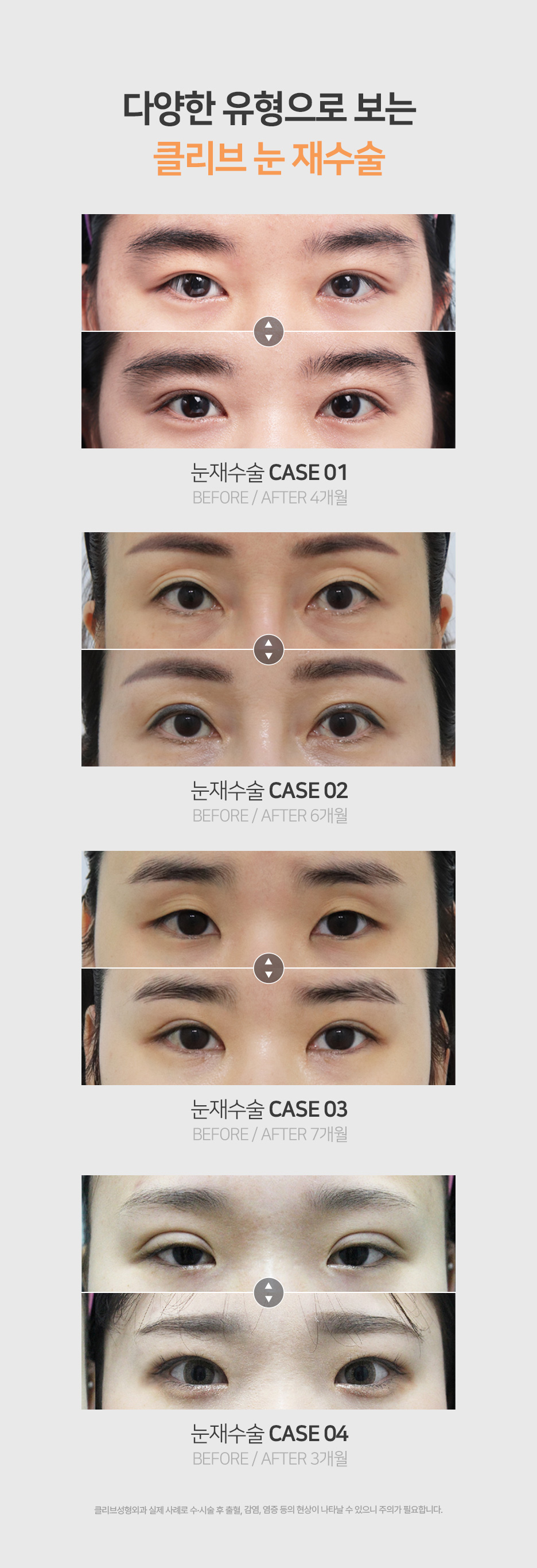 앞트임복원·뒤트임복원, 쌍꺼풀재수술잘하는병원은 언제부터 다시 받을 수 있나요? 사진 7