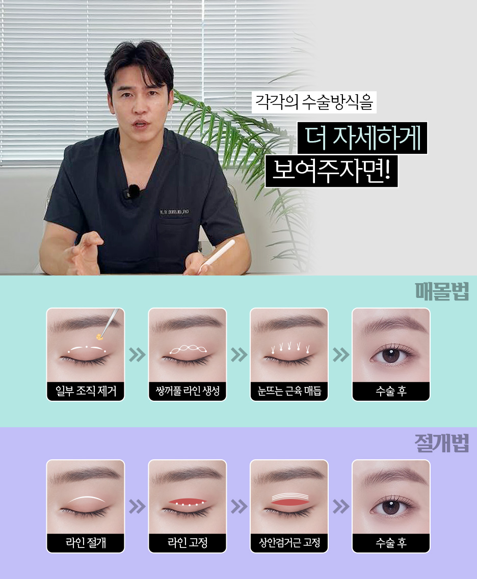 압구정눈재수술 알아본다면? 밑트임재수술과 쌍수절개재수술 전 확인할 것 사진 6