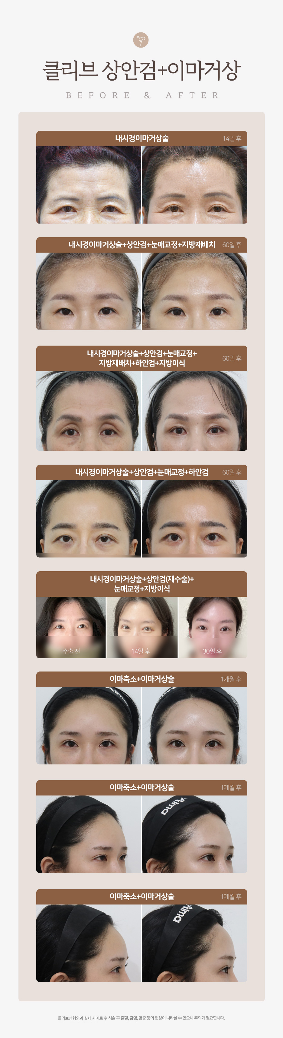 중년 눈성형 고민이라면? 강남하안검수술·중년쌍꺼풀·눈꺼풀처짐수술비용 정리 사진 11