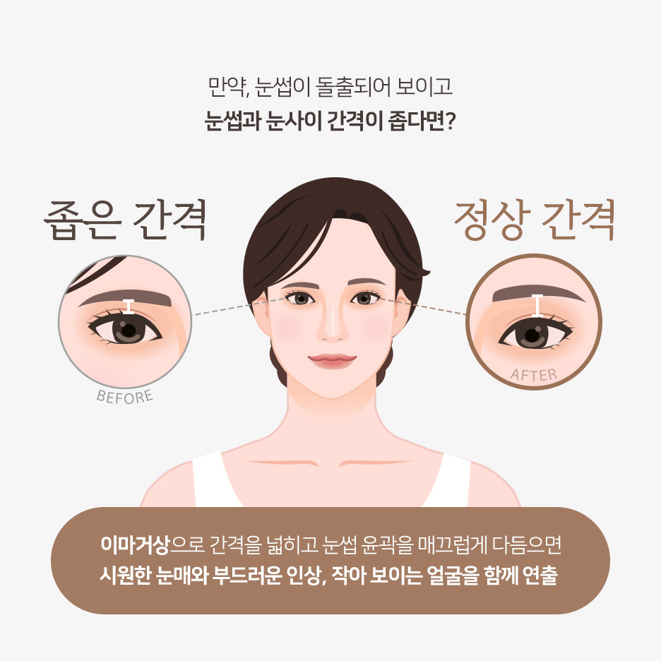 중년 눈성형 고민이라면? 강남하안검수술·중년쌍꺼풀·눈꺼풀처짐수술비용 정리 사진 6