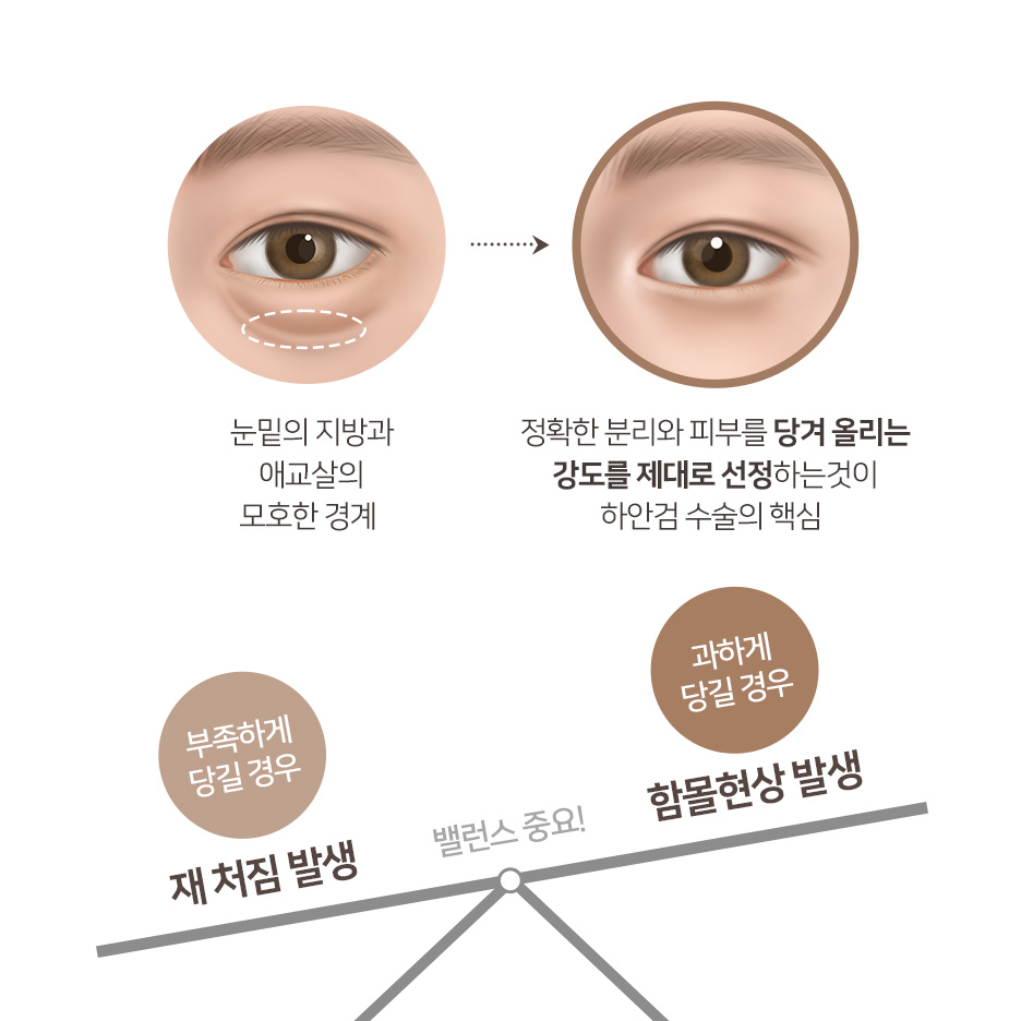 중년 눈성형 고민이라면? 강남하안검수술·중년쌍꺼풀·눈꺼풀처짐수술비용 정리 사진 7