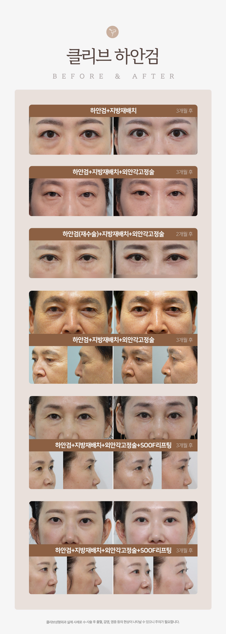 중년 눈성형 고민이라면? 강남하안검수술·중년쌍꺼풀·눈꺼풀처짐수술비용 정리 사진 10