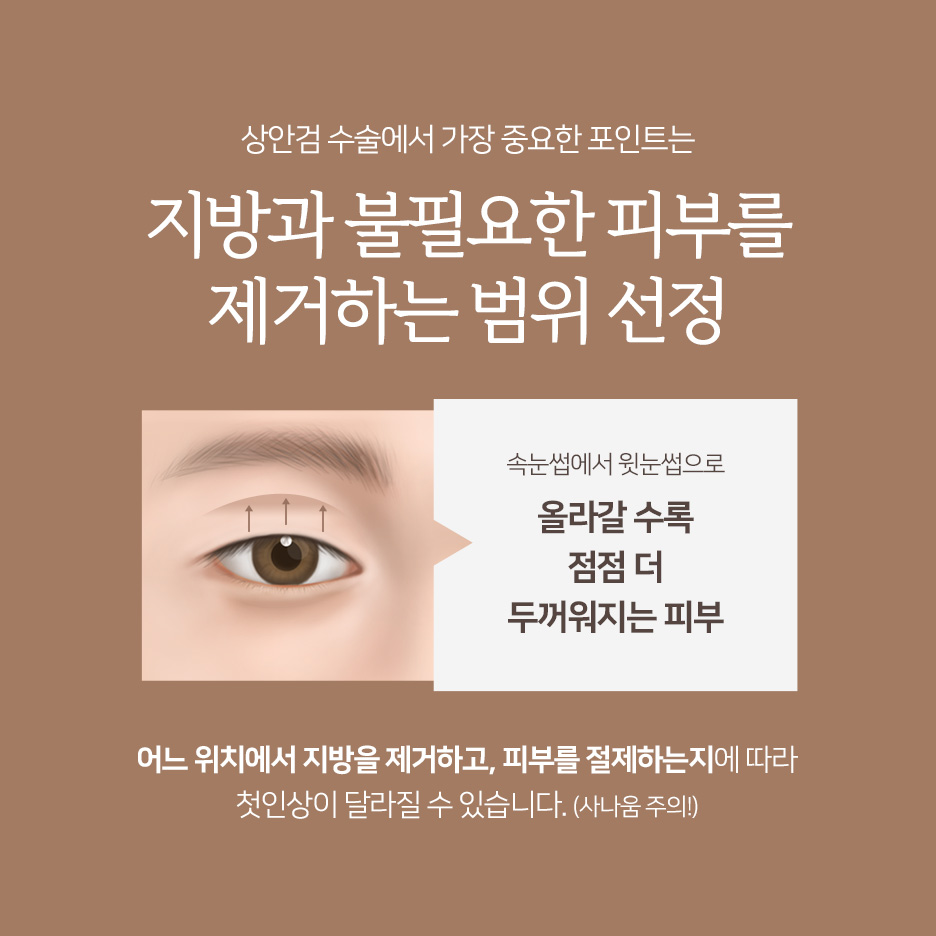 중년 눈성형 고민이라면? 강남하안검수술·중년쌍꺼풀·눈꺼풀처짐수술비용 정리 사진 4