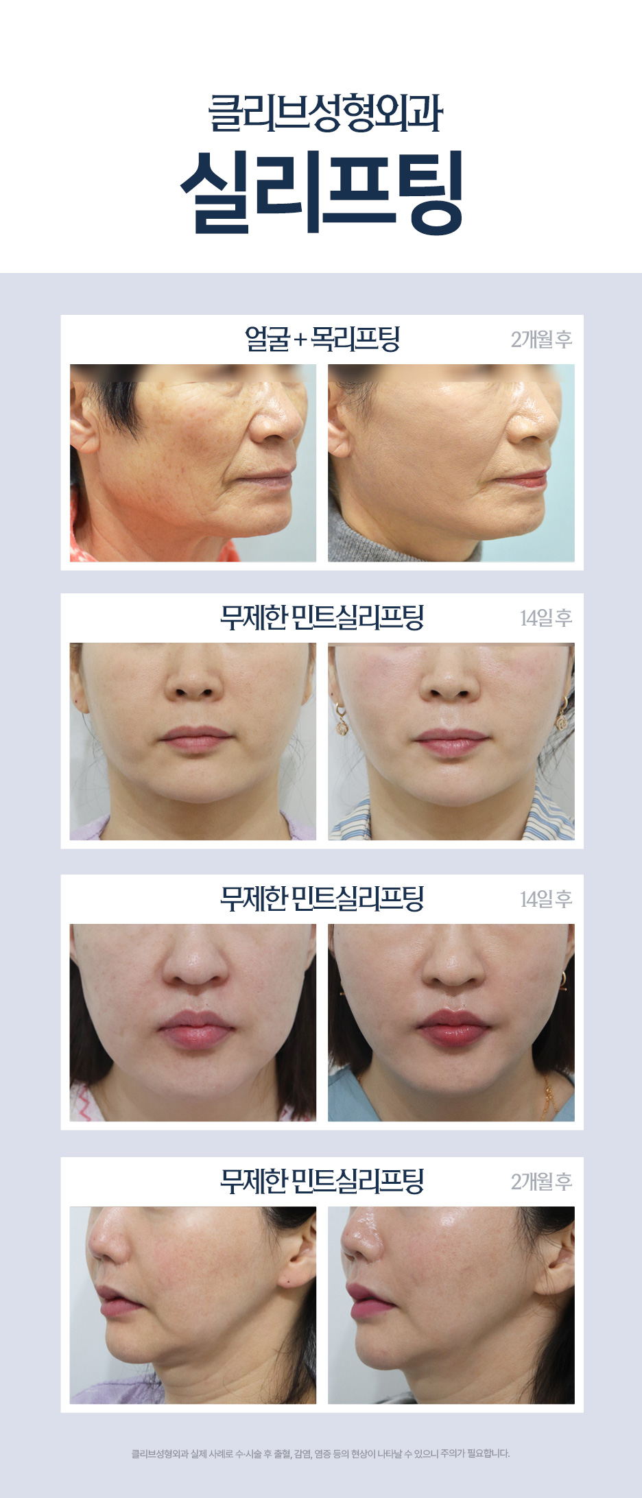 녹는실리프팅, 이중턱실리프팅도 내 얼굴에 맞게? 병원 고민 중이라면 사진 9