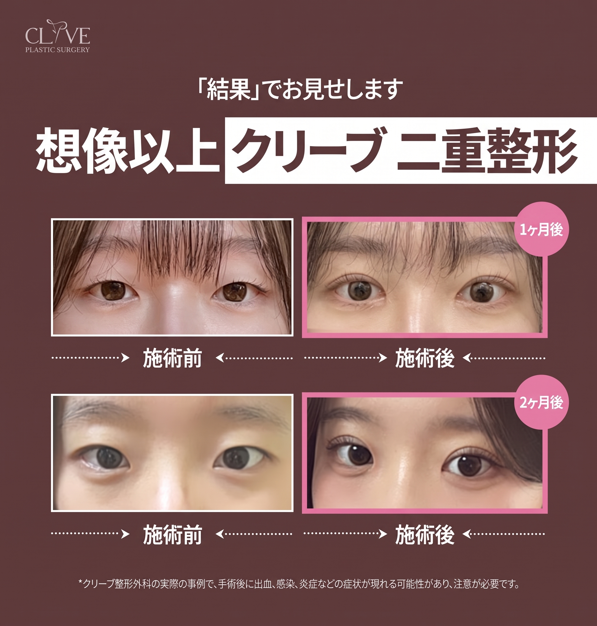 駅三洞（ヨクサムドン）の美容外科、二重ラインの好みだけで選んでも大丈夫？目つき矯正の手術方法まで 사진 8