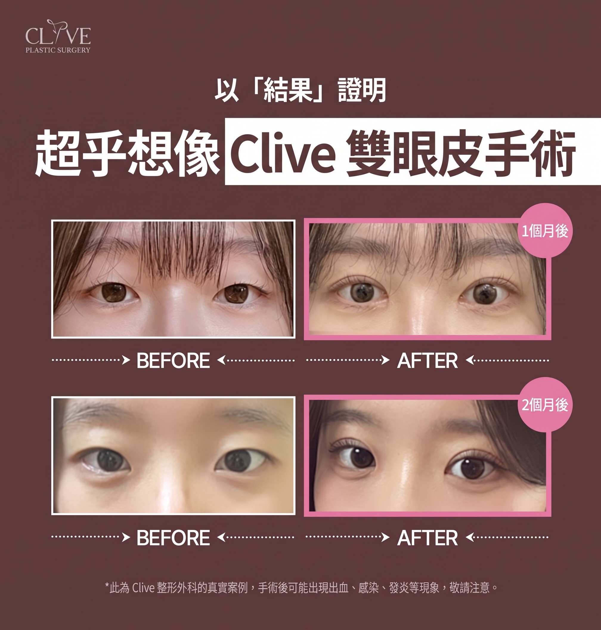 驛三洞整形外科,只看雙眼皮線條來挑選就可以嗎?提眼肌眼型矯正及手術方法解析 사진 8