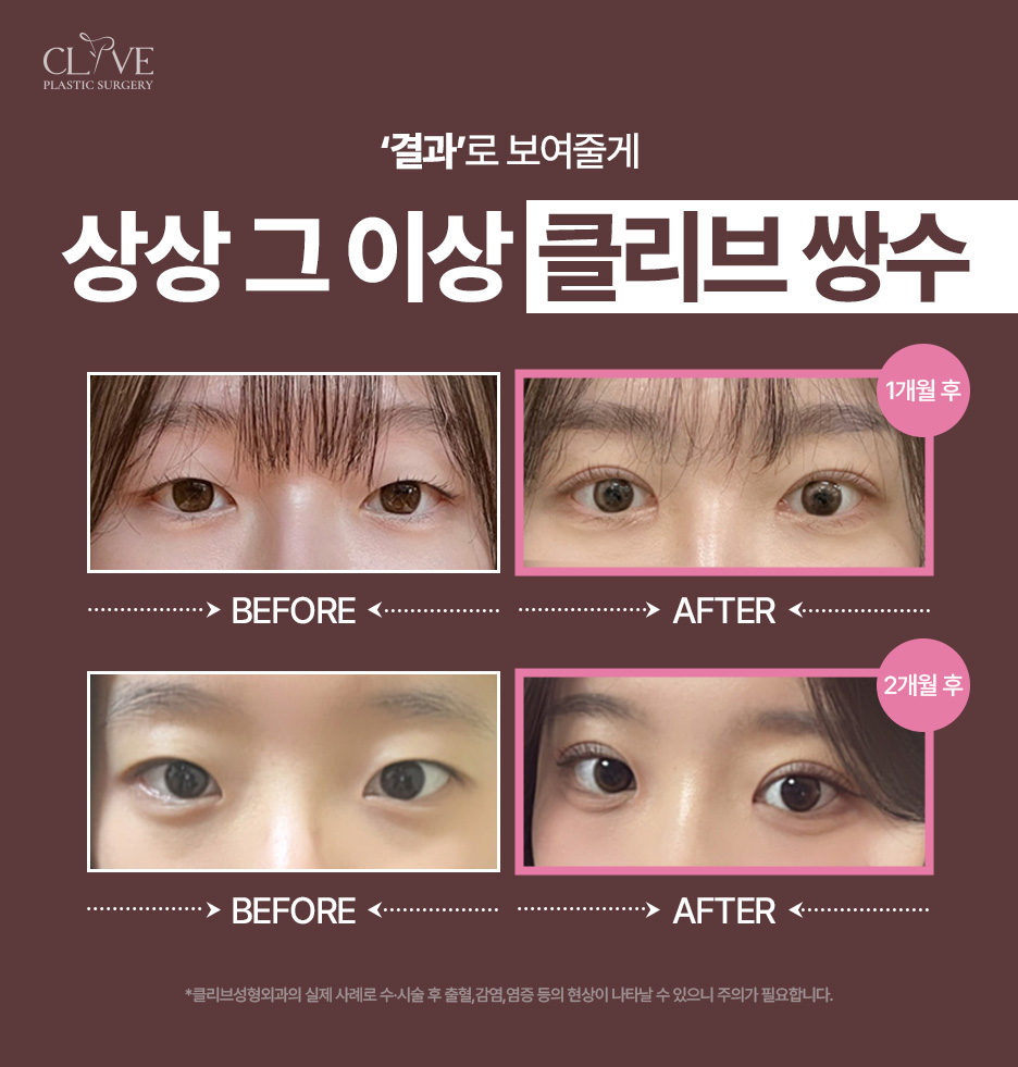 역삼동성형외과, 쌍수 라인만 보고 골라도 될까? 눈매교정 수술 방법까지 사진 8
