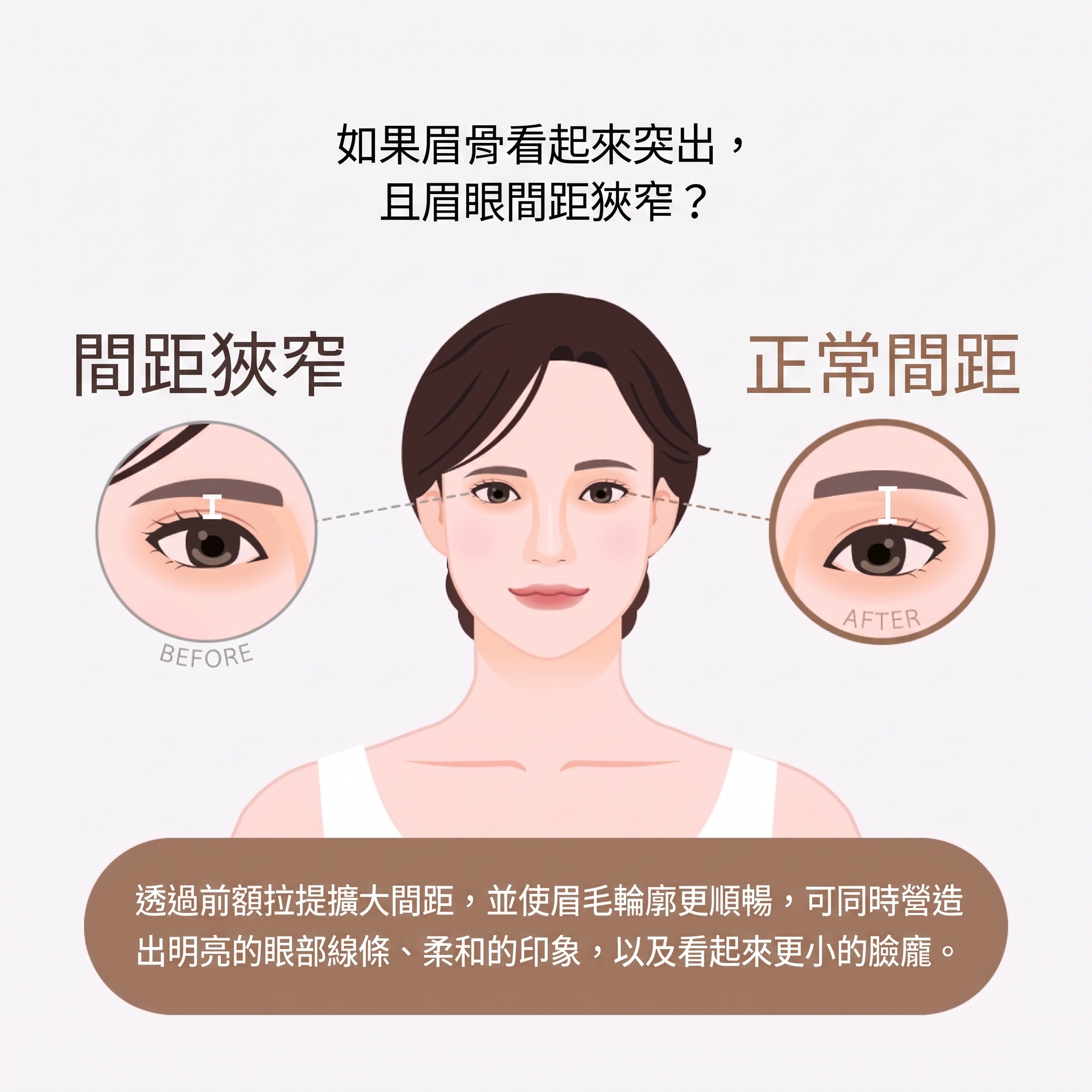 中年眼部手術，為眼皮下垂而煩惱？眼瞼下垂手術前必須了解的要點（中年雙眼皮） 사진 6
