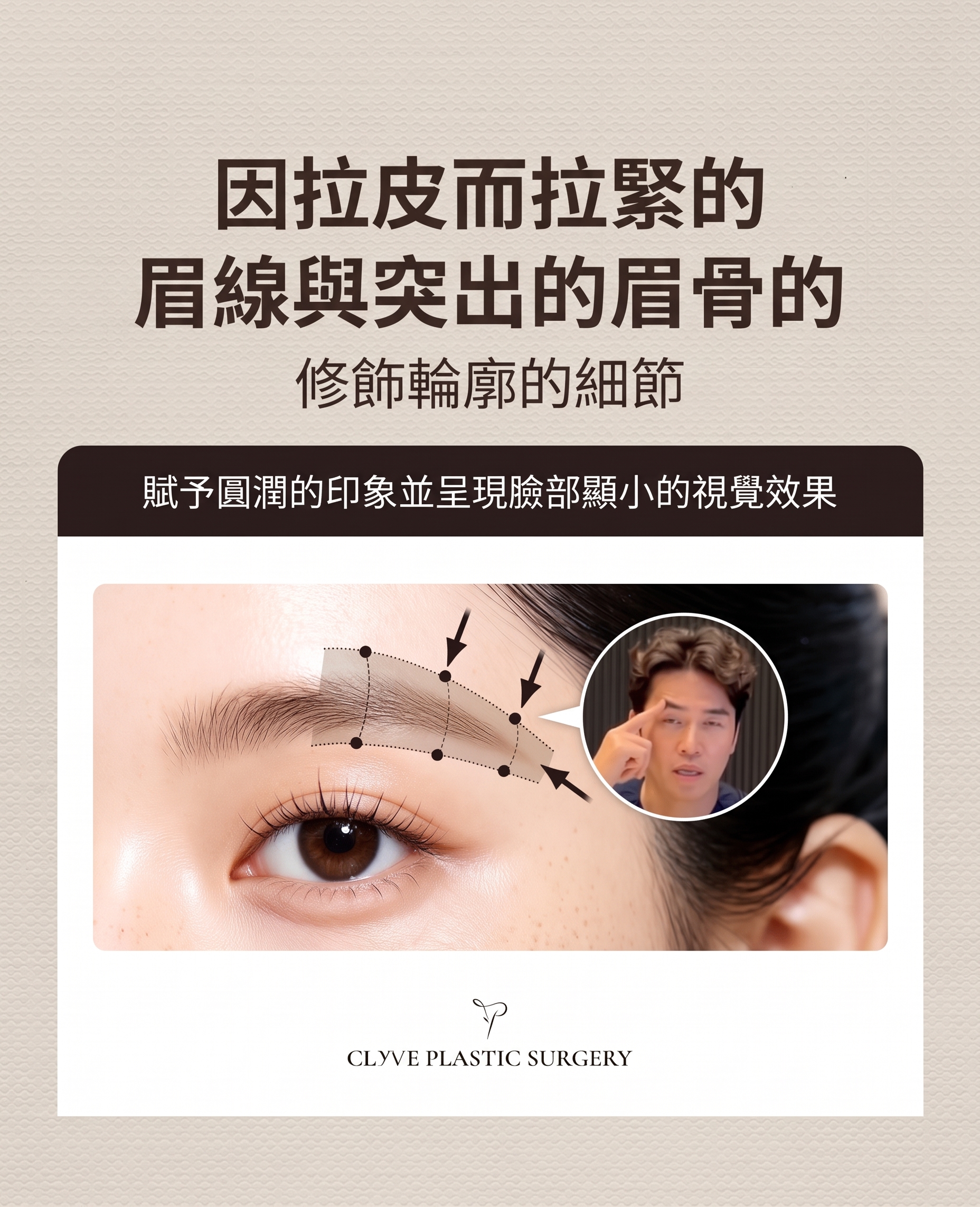 額頭拉皮手術，只要拉額頭就夠了嗎？若連迷你臉部拉皮一起考慮，費用該如何衡量？ 사진 9