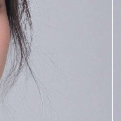 상하안검수술, 눈꺼풀만 보면 될까? 눈썹부터 눈밑쳐짐까지 (상안검하안검수술) 사진 21