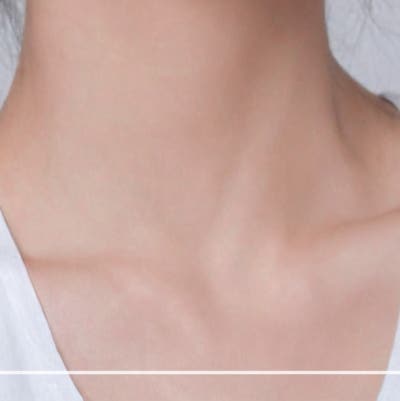 상하안검수술, 눈꺼풀만 보면 될까? 눈썹부터 눈밑쳐짐까지 (상안검하안검수술) 사진 23