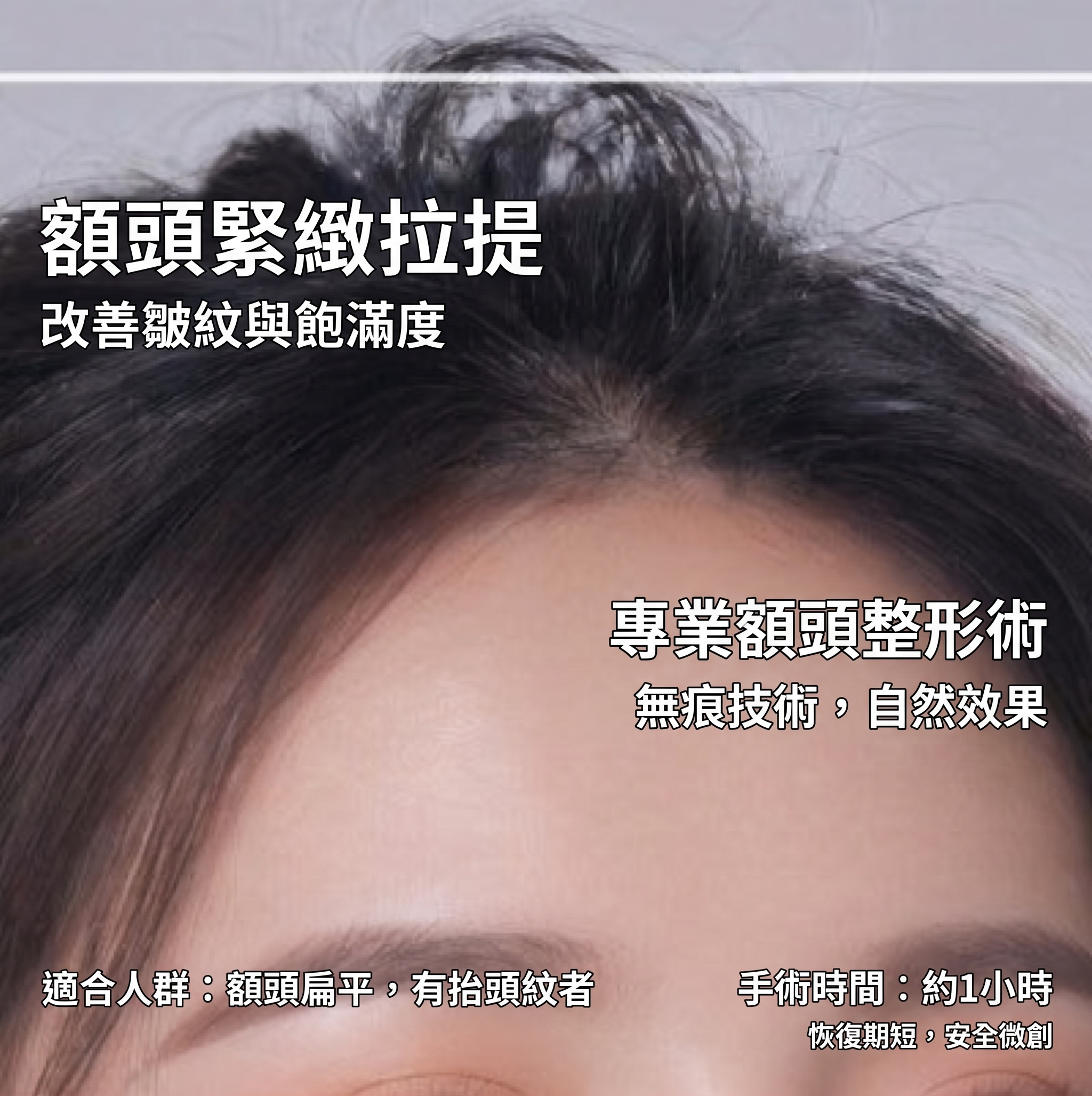 上下眼瞼手術，只看眼皮就夠了嗎？從眉毛到眼袋下垂全面解析（上眼瞼下眼瞼手術） 사진 17
