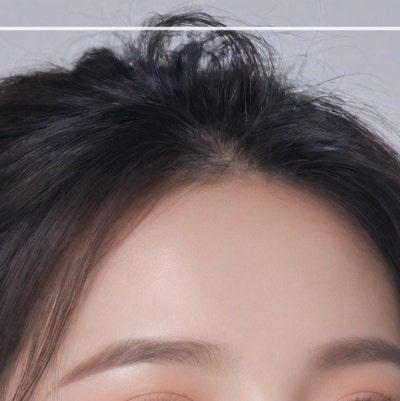 상하안검수술, 눈꺼풀만 보면 될까? 눈썹부터 눈밑쳐짐까지 (상안검하안검수술) 사진 17