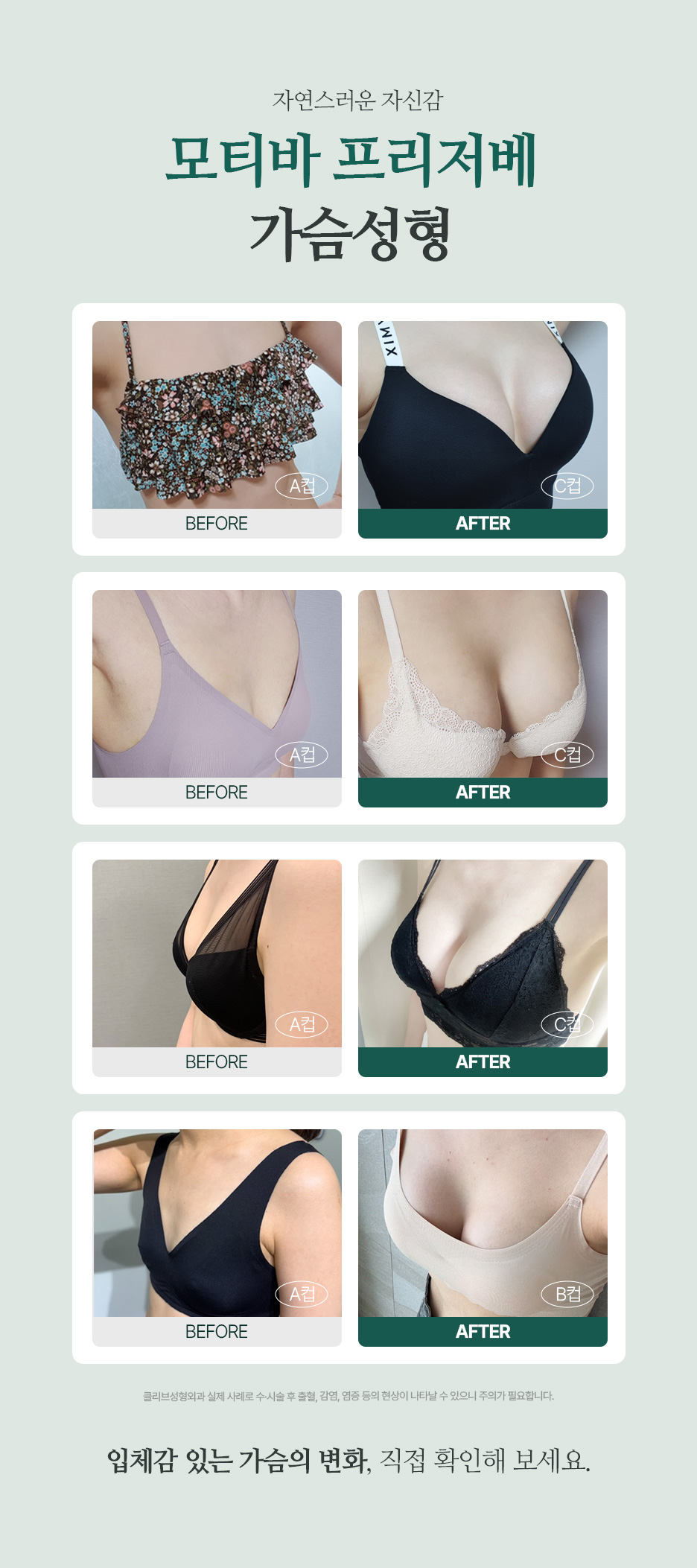 가슴성형종류, 보형물만 쏙? 수술 과정까지 보는 모티바프리저베 사진 5